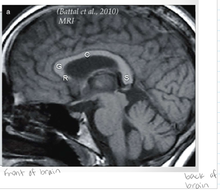 <p>Generally into 4 parts: 1. Rostrum 2. Genu 3. Corpus/Body/Trunk  4. Splenium *Be able to label them*</p>