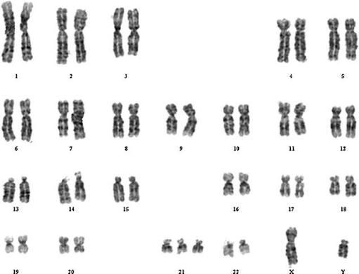 <p>Is this a numerical or structural chromosome abnormality?</p>