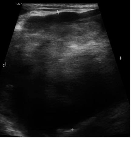 <p>what is seen in the ultrasound of the kidney?</p>
