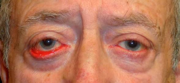 <p>Afección en la que el párpado (generalmente el inferior) se dobla hacia afuera, separándose del ojo.</p>