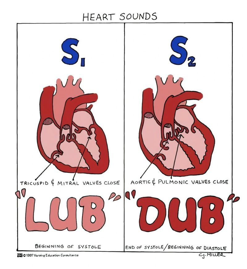 <p>What causes the "dub" heart sound?</p>