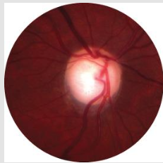 <p>incr intraocular pressure w/in eye leads to incr cupping (bked depression of disc) and atropy. BASE of enlarged cup is pale<br>death of optic N fibers → lose tiny disc vessels</p>