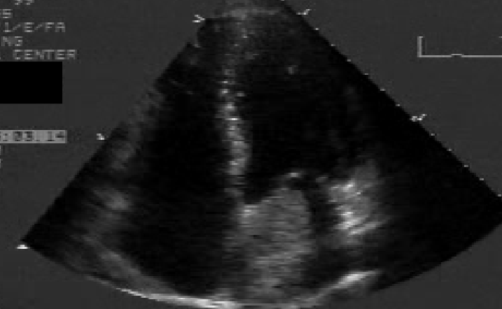 <ul><li><p><u>neoplasm</u> that arises from <span style="color: rgb(255, 119, 0);">endocardial tissue</span></p><ul><li><p><u>80% located</u> in <span style="color: rgb(0, 117, 255);"><strong>LA</strong></span></p></li><li><p><span style="color: rgb(0, 117, 255);">RA</span> <u>2nd</u> most common</p></li></ul></li><li><p>usually attached by a <u>stalk</u> to the <span style="color: rgb(0, 139, 255);">IAS</span></p><ul><li><p><span style="color: rgb(255, 0, 0);">“pedunculated”</span></p></li><li><p>often arises from <span style="color: rgb(0, 124, 255);">IAS</span></p><ul><li><p>near region of <span style="color: rgb(0, 117, 255);"><strong>fossa ovalis</strong></span></p></li></ul></li></ul></li></ul><p></p>