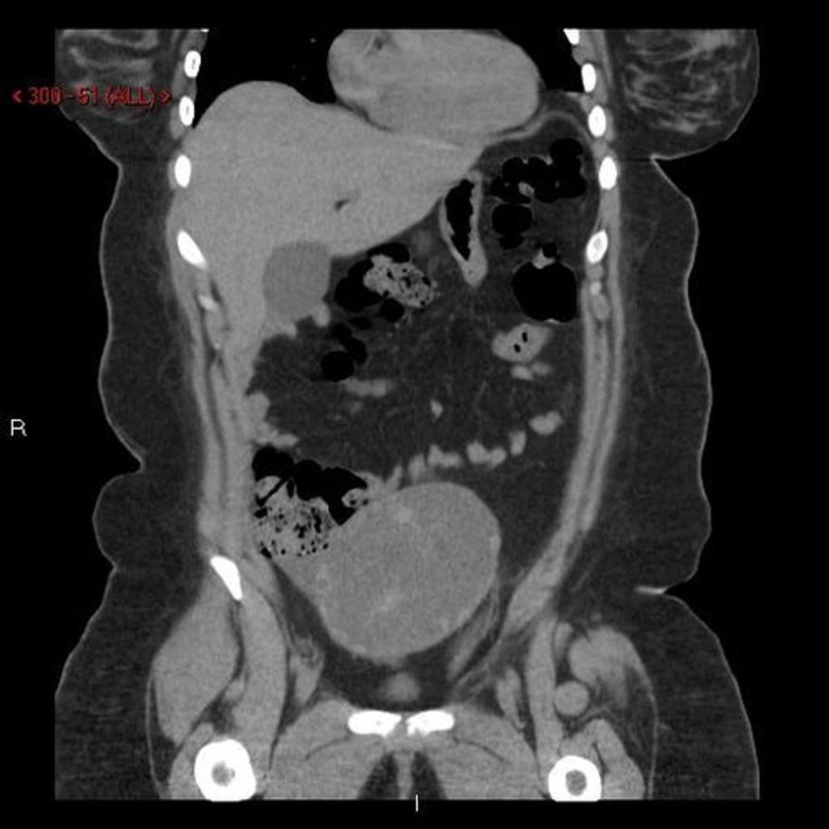 <p>abdominal computed tomography (CT) scan</p>