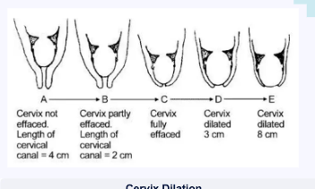 <ol><li><p><strong>Onset to dilation</strong></p><ol><li><p> rupturing of amniotic sac and onset of contractions until full dilation achieved</p></li></ol></li><li><p>Dilation to baby delivery</p><ol><li><p>From the time of full dilation to delivery of baby</p></li></ol></li><li><p>Baby to placenta delivery</p><ol><li><p>From time baby was delivered until placenta was delivered</p></li></ol></li></ol><p></p>
