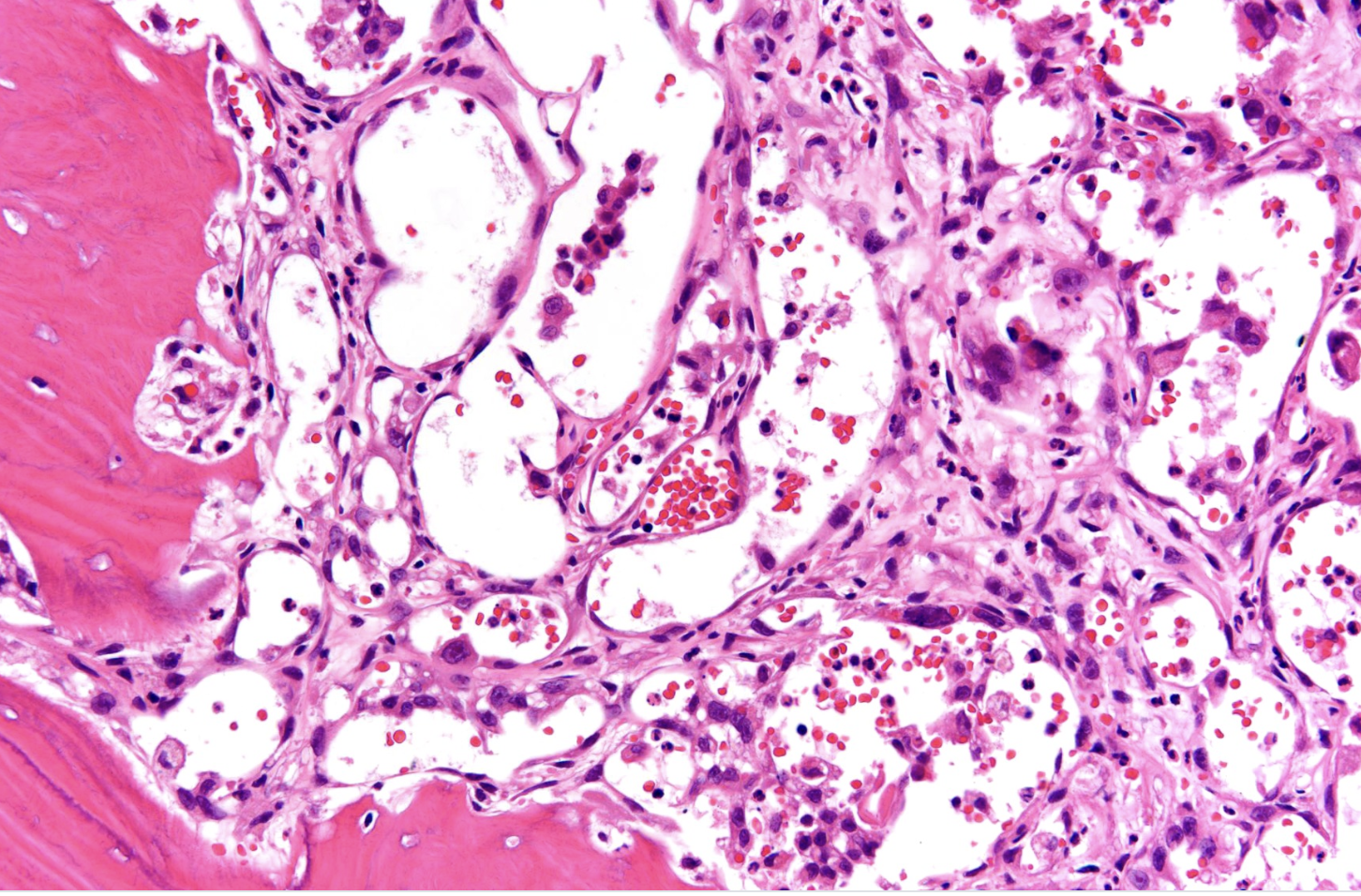 <p>Tumeur du fémur</p><p>diagnostic</p><p>anatomie</p><p>histologie</p><p>IHC </p><p>moléculaire</p><p></p>