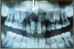 <p>-normal eruption or FAILURE of eruption can both occur</p><p>-displacement or rotation of teeth</p><p>-crowding</p><p>-abnormal diastema / premature space closure</p><p>-dilaceration, delayed or abnormal root development of permanent teeth </p><p>-Cystic formation </p><p>-Eruption into nasal cavity</p>