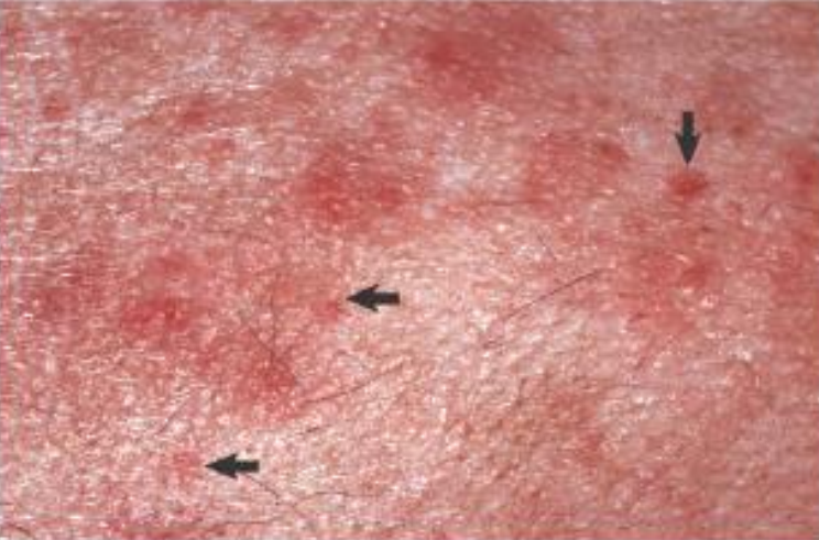 <ul><li><p><strong>primary lesion</strong></p></li><li><p><strong>slightly raised</strong>, red, <1 cm</p></li><li><p>epidermal &amp; dermal inflammation and edema</p></li><li><p>ex. insect bites</p></li></ul><p></p>