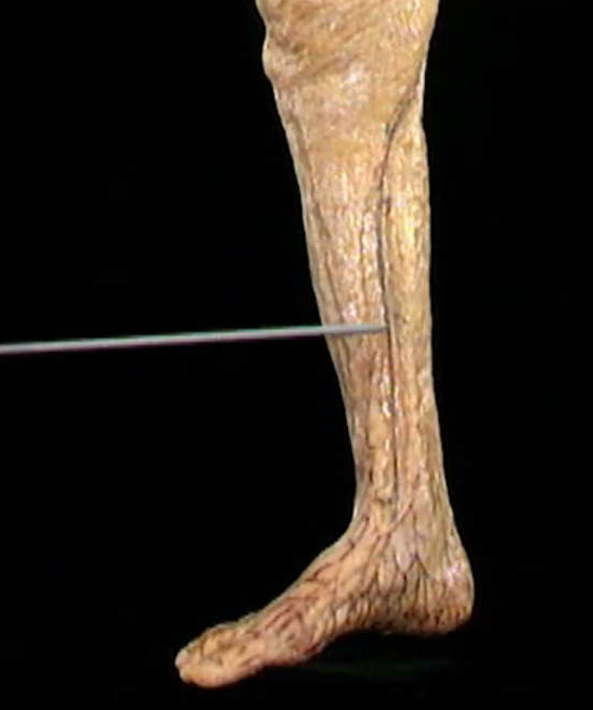 <p>Oppervlakkig, mediaal zicht</p>