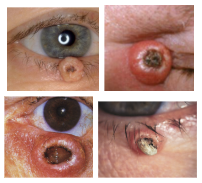 <p>What is the most likely diagnosis ?</p>