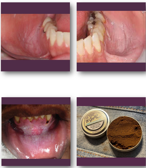 <p>• <strong>White or gray plaque at tobacco placement site</strong></p><p>• Surface may appear <strong>wrinkled or fissured</strong></p><p>• Common in <strong>mandibular vestibule</strong> or sulcus</p><p>• Lesion thickness varies with duration of use</p><p>• Usually asymptomatic</p>
