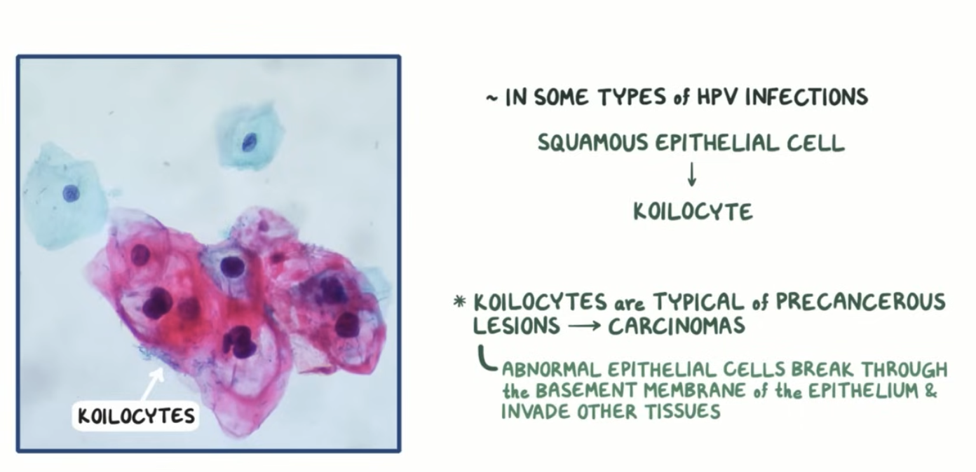 <p><strong>= Abnormal squamous epithelium cell as a result of infection with HR HPV</strong></p><p>→ Typical of precancerous lesions which can develop into carcinomas</p><ul><li><p><strong>Enlarged nucleus</strong></p></li><li><p><strong>Clearing “halo” around the nucleus</strong></p></li><li><p><strong>Condensed chromatin</strong> → indicating <u>no active gene expression </u>occurring</p></li></ul><p></p>