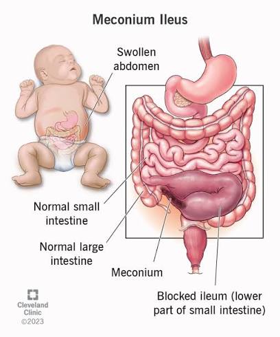 <p>meconium ileus</p>