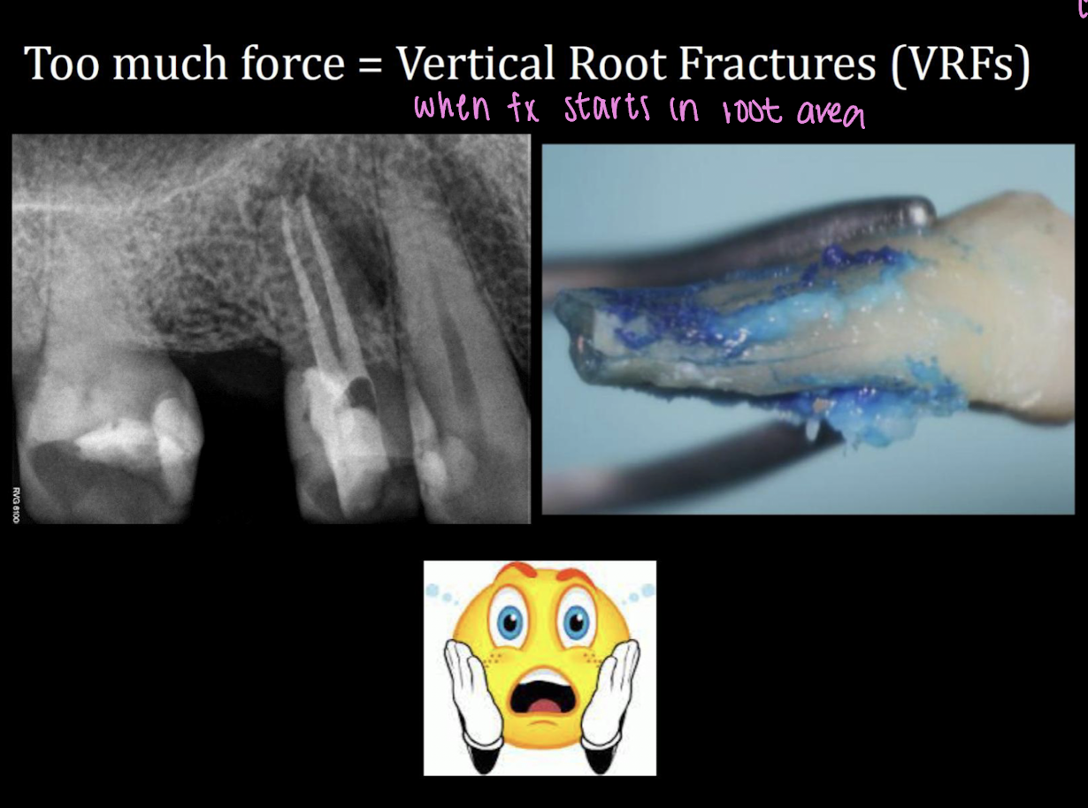 <p>vertical root fractures </p>