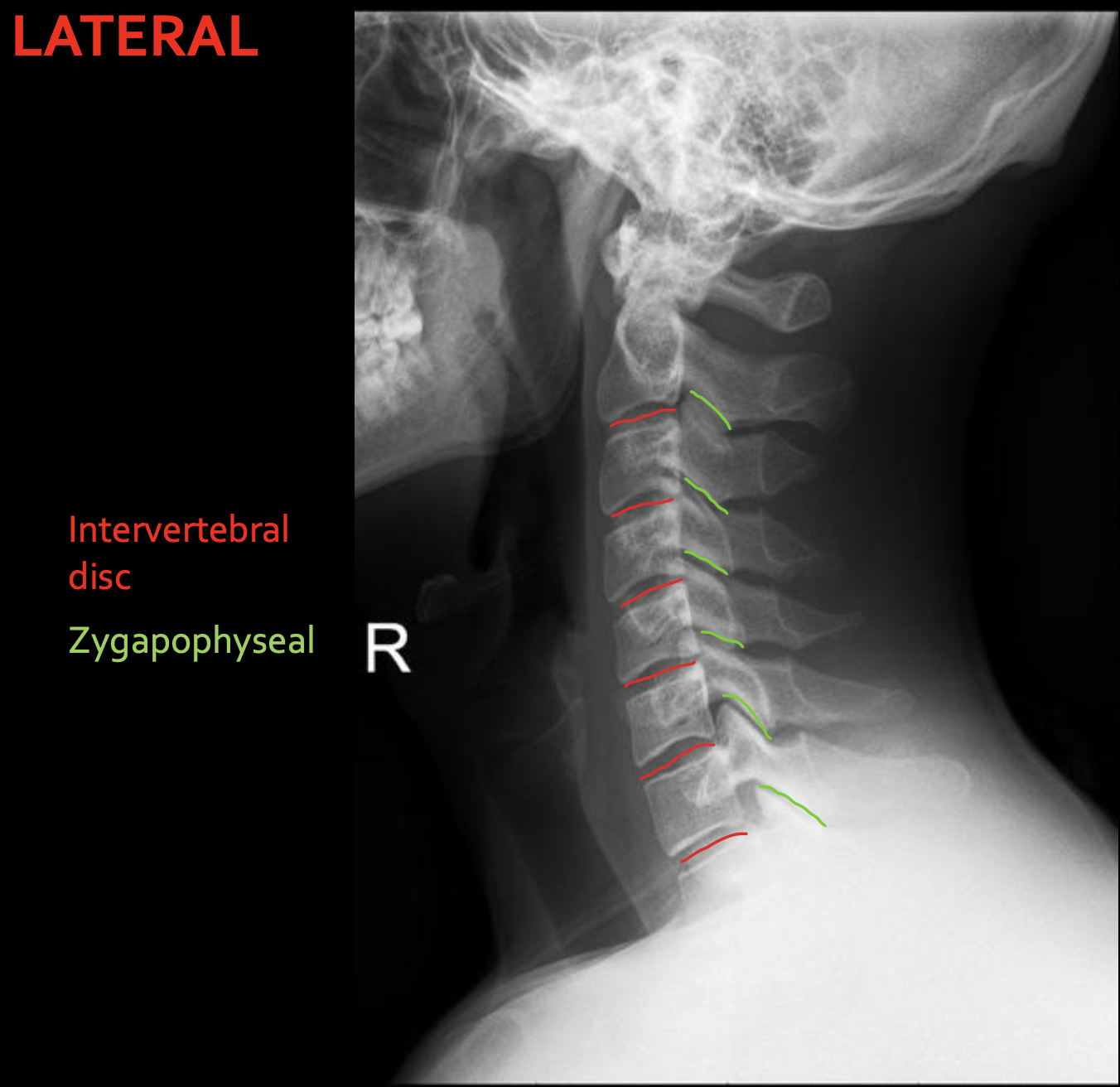 <p>Intervertebral disc</p>