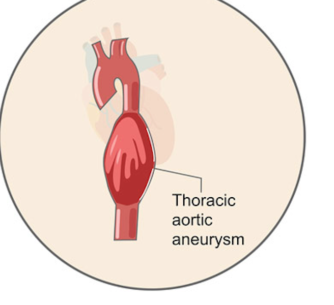 <p><strong>THORACIC AORTIC ANEURYSM</strong></p>