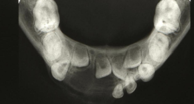 <p>radiolucent lesions; multilocular or unilocular; well defined non-corticated </p>