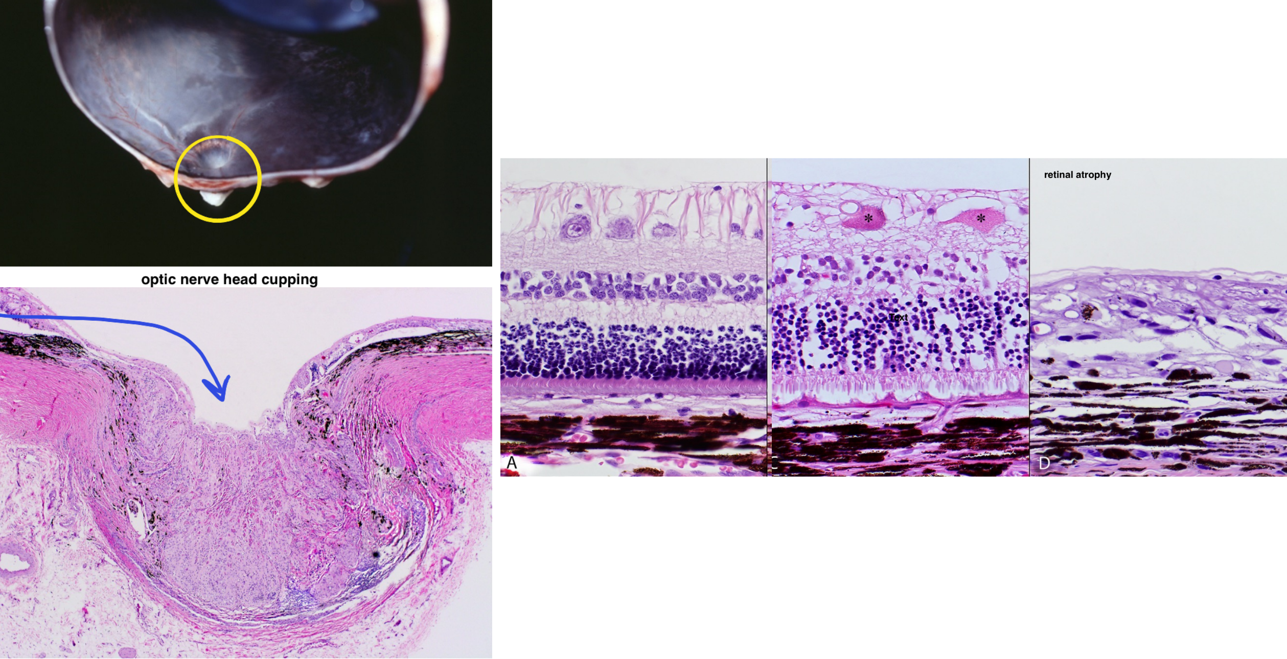 <ul><li><p>retinal atrophy</p><ul><li><p>decreased numbers of retinal ganglion cells</p></li><li><p>atrophy & gliosis of the never fiber layer</p></li><li><p>full thickness retinal atrophy (in dogs only)</p></li></ul></li><li><p>cupping of the optic nerve head</p></li><li><p>end stage changes</p><ul><li><p>buphthalmia (bulging)</p></li><li><p>lens luxation</p></li><li><p>phthisis bulbi (eye shrinks, atrophies)</p></li></ul></li></ul><p></p>