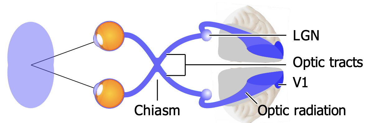 <ul><li><p>The nerve bundles emerging from the chiasm are called the <strong>optic tracts</strong>. They end in the <strong>2 lateral geniculate nuclei (LGN)</strong> in the thalamus, which project via the<strong> optic radiations to primary visual cortex,V1. </strong></p></li><li><p>Optic radiations are going through either the <strong>parietal lobe <em>carrying information from the lower visual field</em> </strong>vs. one looping through the temporal lobe — called <strong>Meyer’s loop</strong> — <strong><em>carrying information from the upper visual field </em></strong></p></li><li><p>Together, the 2 LGN have ~2 million neurons — the same as the number of ganglion cells in the 2 retinas — whereas V1 has far more neurons, ~300 million.</p></li></ul><p></p>