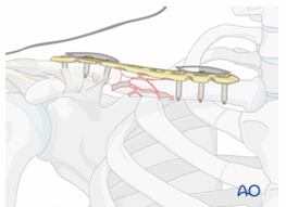 <p><u>Indications</u>:</p><ul><li><p>shortening &amp; displacement more than 2cm</p></li><li><p>shoulder pathology + neurovascular repairs needed</p></li></ul><p></p><p><u>Post Operation:</u></p><ul><li><p>Sling 1-2 weeks, NWB 6 weeks, PROM, resistance from 6wks</p></li></ul><p></p>