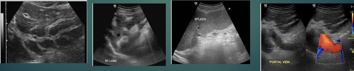 <p>Caused by a parasitic tapeworm, sometimes described as a turtle shell appearance</p><p>Splenomegaly with portal vein and splenic vein dilatation</p>