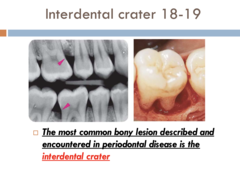 <p>Intrabony defect with 2 bony walls.</p><p>(Explanation: Crater defects, with two walls, offer moderate regenerative potential, commonly treated with guided tissue regeneration to support bone fill.)</p>