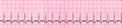 <p>Vagal manuever.</p>