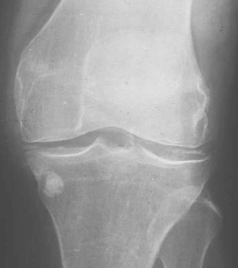 <p><span>deposition of calcium pyrophosphate crystals in joint cartilage </span></p>