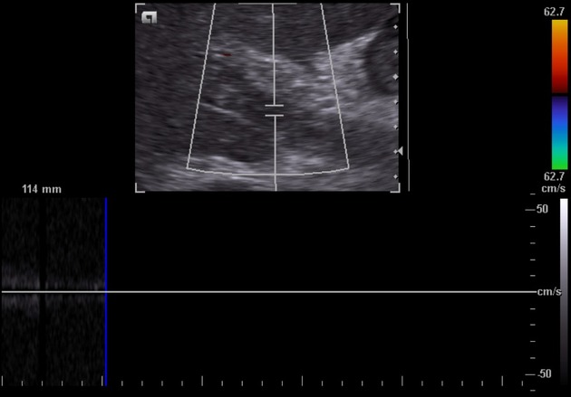 <p>Portail vein. Describe findings and what you suspect</p>
