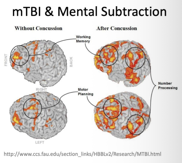 <p><span>Brain is noisy &amp; inefficient after concussion meaning:</span></p><ul><li><p class="p2"><span>You can’t filter sensory stimuli</span></p></li><li><p class="p2"><span>You can’t easily maintain balance &amp; move through environment</span></p></li><li><p class="p2"><span>You can’t use multiple systems at the same time</span></p></li><li><p class="p2"><span>You get easily fatigued</span></p></li></ul><p></p>