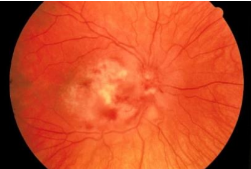 <p>You can have<strong> painless vision loss</strong> especially in a patient with HIV and splenomegaly.</p>