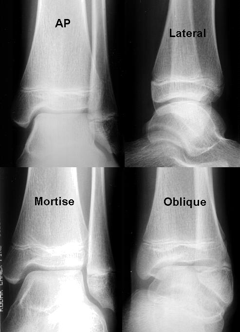 <p><mark data-color="#f6bbf8" style="background-color: rgb(246, 187, 248); color: inherit;">Ankle mortise joint space open between medial and lateral malleoli.</mark></p><p>Minimal superimposition at the distal tibiofibular joint.</p><p></p>