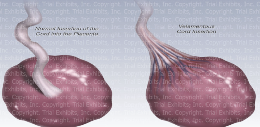 <p><span style="color: yellow;">velamentous cord insertion</span> (umbilical cord inserts into fetal membranes rather than placenta)</p>
