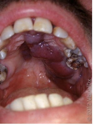 <p>Which of the following viruses is most likely associated with this condition?</p>