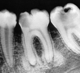 <p><strong>aka:</strong> <em>focal sclerosing osteitis, bony scar, condensing osteitis</em></p><p>common to<span style="color: red;"> young adults</span></p><p>a common phenomenon, usually seen at the apex of a tooth with<span style="color: red;"> long-standing, low-grade pulpitis</span></p><ul><li><p>radiographic appearance:</p><ul><li><p><span style="color: red;">increased radiopacity</span></p></li></ul></li><li><p>tx:</p><ul><li><p><span style="color: red;">no treatment</span> (physiologic bone reaction)</p></li></ul></li></ul><p></p>