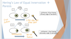 <p>Hering's Law of Equal Innervation -- LLR Paresis (Pic)</p>