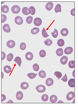 <p>- mechanical red cell damage: red cell fragments; anaemia</p><p>.</p><p>- "Microangiopathic haemolytic anaemia"</p><p>- haemolytic anaemia means haemolysis of blood, premature red cell destruction</p><p>- micro means small, angio is vessel, pathic means pathology</p><p>- term doesnt really make sense but thats what we term fragmentation haemolysis</p><p>- there are a number of entities that can cause it</p><p>.</p><p>RED CELLS EXPOSED TO AN ABNORMAL SURFACE:</p><p>- Heart valve; pinhole lesion in heart</p><p>- Fibrin stands in the blood vessels</p><p>.</p><p>RED CELL FRAGMENTATION "SCHISTOCYTES"</p><p>Intravascular Haemolysis (Inside Blood vessel)</p><p>- Disseminated intravascular coagulation (DIC)</p><p>- Thrombotic Thrombocytopenic purpura</p><p>- Haemolytic uraemic syndrome</p><p>- Malignant hypertension</p><p>- Drugs; graft-versus-host disease</p>