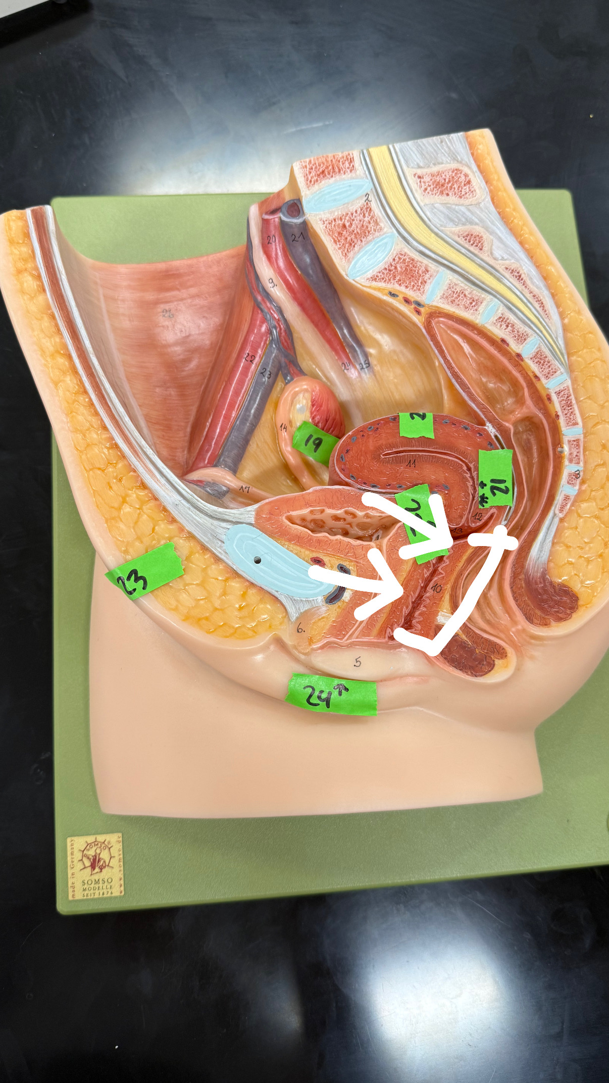 <p>squiggly dark red line under the uterus, </p>