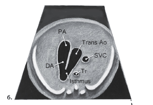 <p>“V” is formed by the merging of the transverse aortic arch and isthmus and the pulmonary trunk and ductus arteriosus </p>