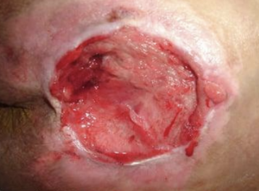<p>full-thickness skin loss with damage to muscle, bone, or supporting structures</p>