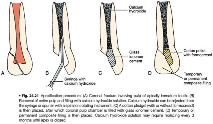 <p>if the apex of a mature tooth has moved <span style="color: rgb(255, 0, 0);">more than 1mm in any direction</span>, pulpal degeneration will occur</p>