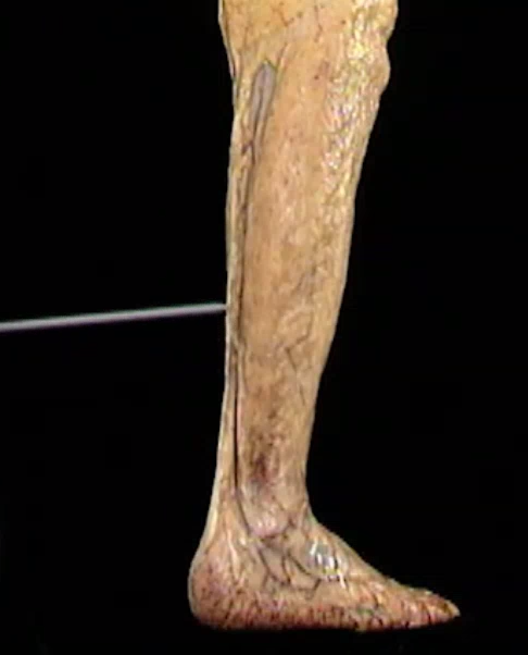 <p>Oppervlakig, lateraal zicht</p>