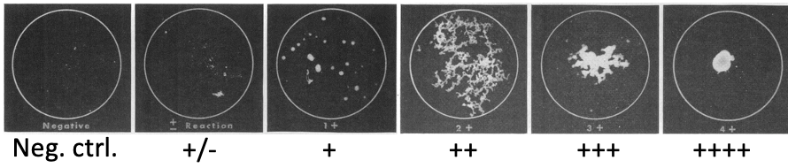 <p>Mainly serologic test: MAT (microscopic agglutination testi) </p><p>it is high specificity, low sensitivity, cost saving) </p>