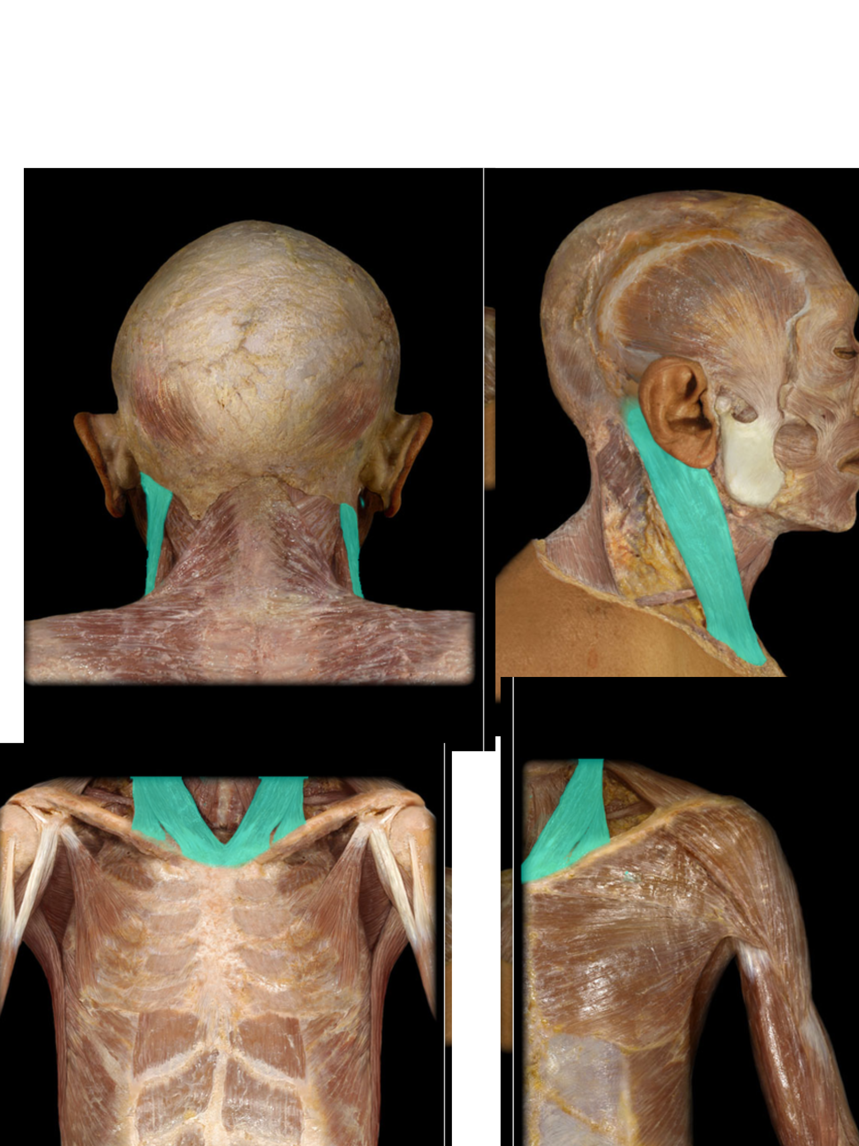 <p>Sternocleidomastoid m.</p>