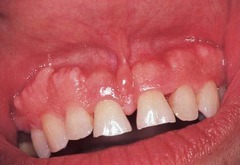 <p>benign bony growth (tori) found on the alveolar ridges. Can be caused by genetics, bruxism, grinding, or age</p>