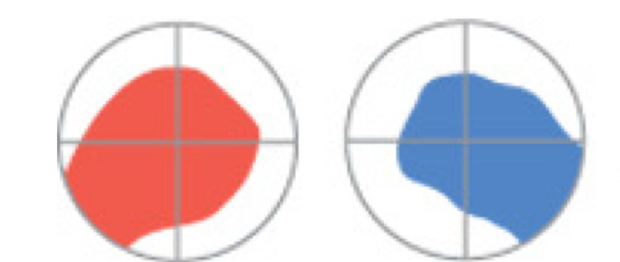 <p>loss of sight in one eye</p><ul><li><p>due to damage to retina or optic nerve </p></li></ul><p></p>