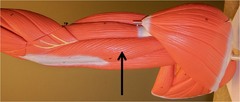 <p>three headed muscle on the posterior side of the upper arm; extends forearm</p><p>origin: infraglenoid tubercle and posterior shaft of humerus</p><p>insertion: olecranon process</p><p>action: extends elbow and shoulder</p>