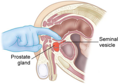 <p>Anterior rectal wall.</p>