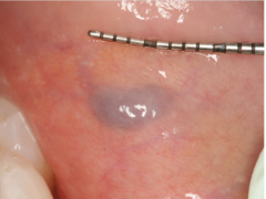 <p>How would you describe the varicosity?</p>