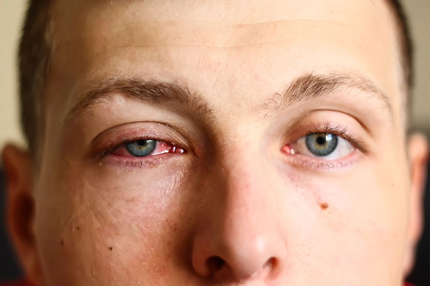 <p>infection of the conjunctiva (pinkeye)</p>